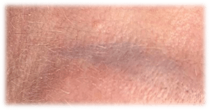 Brow Tattoo Removal (After) 1 Session