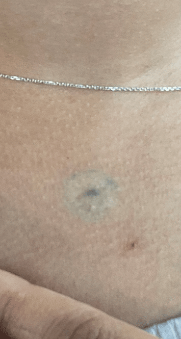 Bullseye Tattoo Removal (After2)