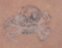 Skull Tattoo Removal (After) 1 Session
